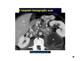 Computertomographyscan
Enlarged paraaortic LN
48
 