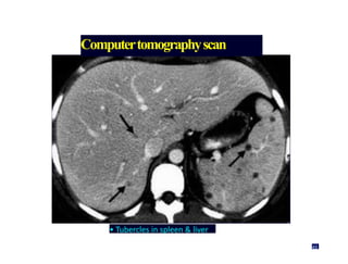 Computertomographyscan
• Tubercles in spleen & liver
49
 