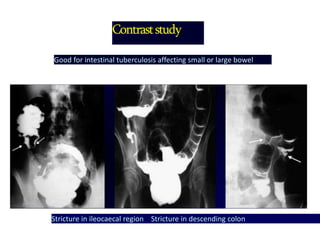 Contraststudy
Good for intestinal tuberculosis affecting small or large bowel
Stricture in ileocaecal region Stricture in descending colon
 