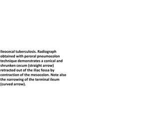 Ileocecal tuberculosis. Radiograph
obtained with peroral pneumocolon
technique demonstrates a conical and
shrunken cecum (straight arrow)
retracted out of the iliac fossa by
contraction of the mesocolon. Note also
the narrowing of the terminal ileum
(curved arrow).
 