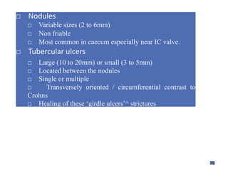 □ Nodules
□ Variable sizes (2 to 6mm)
□ Non friable
□ Most common in caecum especially near IC valve.
□ Tubercular ulcers
□ Large (10 to 20mm) or small (3 to 5mm)
□ Located between the nodules
□ Single or multiple
□ Transversely oriented / circumferential contrast to
Crohns
□ Healing of these ‘girdle ulcers’^ strictures
□ Deformed and edematous ileocaecal valve
57
 