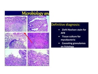 Definitive diagnosis:
• Ziehl-Neelsen stain for
AFB
• Tissue culture for
mycobacteria
• Caseating granulomas
on histology
 