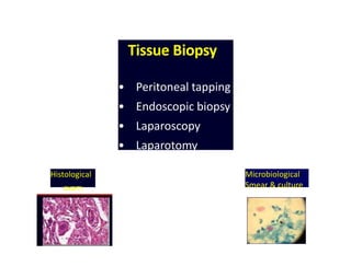 Histological
exam
Tissue Biopsy
• Peritoneal tapping
• Endoscopic biopsy
• Laparoscopy
• Laparotomy
Microbiological
Smear & culture
 