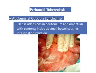 PeritonealTuberculosis
• Abdominal Cocoon Syndrome
— Dense adhesions in peritoneum and omentum
with contents inside as small bowel causing
intestinal obstruction
 