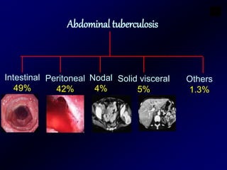 Intestinal
49%
Peritoneal
42%
Nodal
4%
Solid visceral
5%
Abdominal tuberculosis
Others
1.3%
 