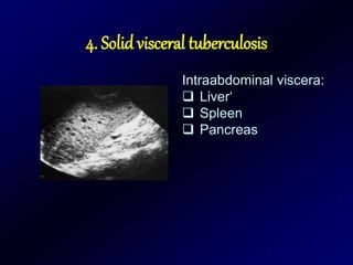 4. Solid visceral tuberculosis
Intraabdominal viscera:
 Liver‘
 Spleen
 Pancreas
 