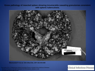 Gross pathology of resected spleen showing innumerable caseating granulomas consistent
with splenic tuberculosis.
Mackowiak P A et al. Clin Infect Dis. 2011;52:418-420
The Author 2011. Published by Oxford University Press on behalf of the Infectious Diseases
Society of America. All rights reserved. For Permissions, please e-mail:
journals.permissions@oup.com.
 