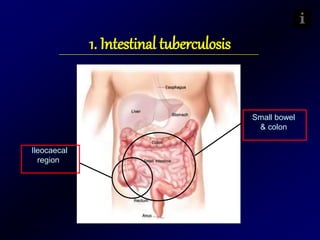 1. Intestinal tuberculosis
Ileocaecal
region
Small bowel
& colon
 