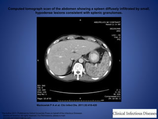 Computed tomograph scan of the abdomen showing a spleen diffusely infiltrated by small,
hypodense lesions consistent with splenic granulomas.
Mackowiak P A et al. Clin Infect Dis. 2011;52:418-420
The Author 2011. Published by Oxford University Press on behalf of the Infectious Diseases
Society of America. All rights reserved. For Permissions, please e-mail:
journals.permissions@oup.com.
 