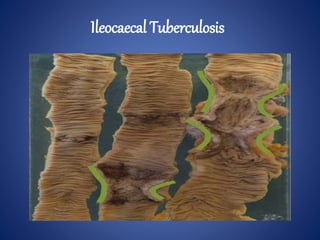 Ileocaecal Tuberculosis
 