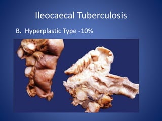 B. Hyperplastic Type -10%
Ileocaecal Tuberculosis
 