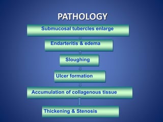 PATHOLOGY
Submucosal tubercles enlarge
Endarteritis & edema
Sloughing
Ulcer formation
Accumulation of collagenous tissue
Thickening & Stenosis
 