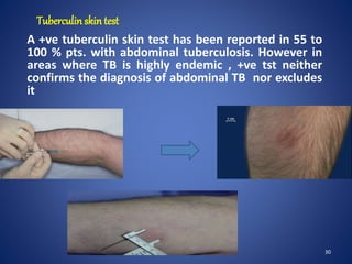 Tuberculinskin test
A +ve tuberculin skin test has been reported in 55 to
100 % pts. with abdominal tuberculosis. However in
areas where TB is highly endemic , +ve tst neither
confirms the diagnosis of abdominal TB nor excludes
it
30
 