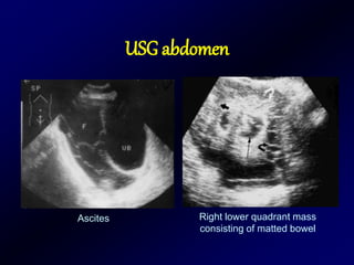 USG abdomen
Ascites Right lower quadrant mass
consisting of matted bowel
 