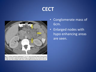 CECT
• Conglomerate mass of
6cm.
• Enlarged nodes with
hypo enhancing areas
are seen.
 