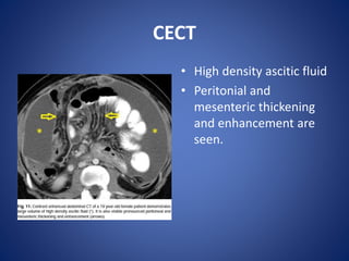 CECT
• High density ascitic fluid
• Peritonial and
mesenteric thickening
and enhancement are
seen.
 