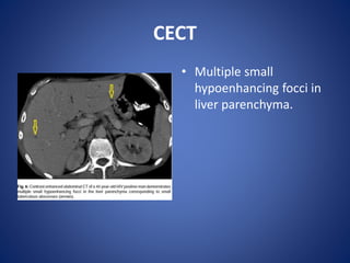 CECT
• Multiple small
hypoenhancing focci in
liver parenchyma.
 