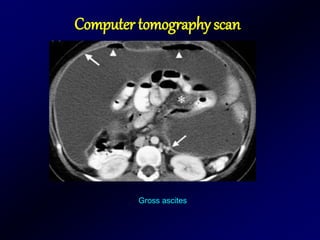 Computer tomography scan
Gross ascites
 