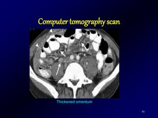 45
Thickened omentum
Computer tomography scan
 