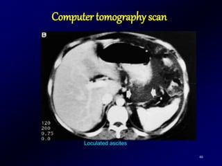 46
Loculated ascites
Computer tomography scan
 