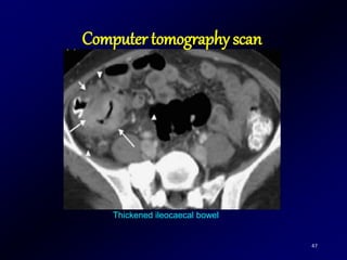 47
Thickened ileocaecal bowel
Computer tomography scan
 