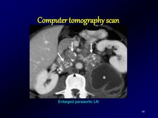 48
Enlarged paraaortic LN
Computer tomography scan
 