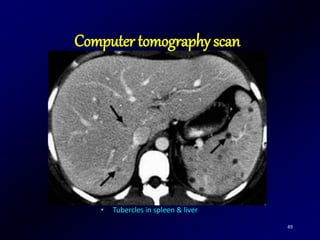 49
• Tubercles in spleen & liver
Computer tomography scan
 