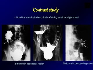 Contrast study
Stricture in ileocaecal region Stricture in descending colon
• Good for intestinal tuberculosis affecting small or large bowel
 
