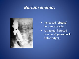 Barium enema:
• increased (obtuse)
ileocaecal angle
• retracted, fibrosed
caecum (“goose neck
deformity”) ;
 