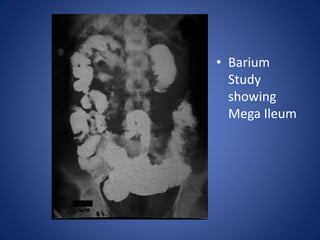 • Barium
Study
showing
Mega Ileum
 