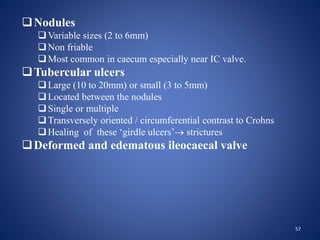 Nodules
Variable sizes (2 to 6mm)
Non friable
Most common in caecum especially near IC valve.
Tubercular ulcers
Large (10 to 20mm) or small (3 to 5mm)
Located between the nodules
Single or multiple
Transversely oriented / circumferential contrast to Crohns
Healing of these ‘girdle ulcers’ strictures
Deformed and edematous ileocaecal valve
57
 