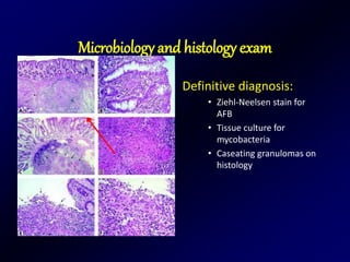 Microbiology and histology exam
Definitive diagnosis:
• Ziehl-Neelsen stain for
AFB
• Tissue culture for
mycobacteria
• Caseating granulomas on
histology
 