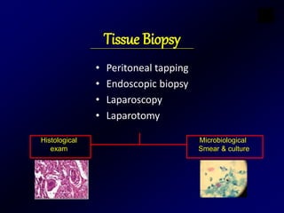 Tissue Biopsy
• Peritoneal tapping
• Endoscopic biopsy
• Laparoscopy
• Laparotomy
Histological
exam
Microbiological
Smear & culture
 