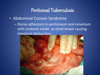 • Abdominal Cocoon Syndrome
– Dense adhesions in peritoneum and omentum
with contents inside as small bowel causing
intestinal obstruction
Peritoneal Tuberculosis
 