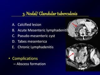 3. Nodal/ Glandular tuberculosis
A. Calcified lesion
B. Acute Mesenteric lymphadenitis
C. Pseudo-mesenteric cyst
D. Tabes mesenterica
E. Chronic Lymphadenitis
• Complications
– Abscess formation
 