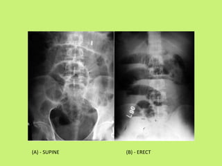 (A) - SUPINE (B) - ERECT
 