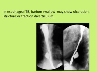 In esophageal TB, barium swallow may show ulceration,
stricture or traction diverticulum.
 