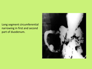 Long segment circumferential
narrowing in first and second
part of duodenum.
 
