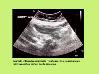 Multiple enlarged conglomerate lymphnodes in retroperitoneum
with hypoechoic centers due to caseation.
 