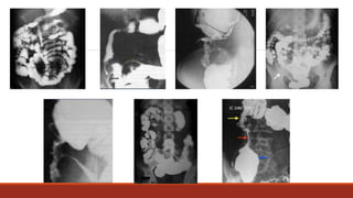 Abdominal Tuberculosis.pptx