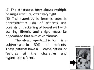 (2) The stricturous form shows multiple
or single stricture, often very tight.
(3) The hypertrophic form is seen in
approximately 10% of patients and
consists of thickening of bowel wall with
scarring, fibrosis, and a rigid, mass-like
appearance that mimics carcinoma.
The ulcerohypertrophic form is a
subtype seen in 30% of patients.
These patients have a combination of
features of the ulcerative and
hypertrophic forms.
 