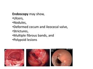 Endoscopy may show,
•Ulcers,
•Nodules,
•Deformed cecum and ileocecal valve,
•Strictures,
•Multiple fibrous bands, and
•Polypoid lesions
 