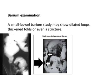 Barium examination:
A small-bowel barium study may show dilated loops,
thickened folds or even a stricture.
 