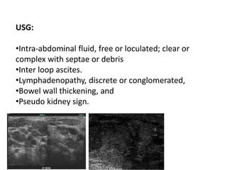 USG:
•Intra-abdominal fluid, free or loculated; clear or
complex with septae or debris
•Inter loop ascites.
•Lymphadenopathy, discrete or conglomerated,
•Bowel wall thickening, and
•Pseudo kidney sign.
 