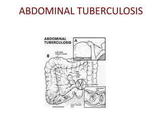 ABDOMINAL TUBERCULOSIS
 
