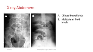 X ray Abdomen:
A. Dilated bowel loops
B. Multiple air fluid
levels
7/7/2015 Dr.S.K.Jain, Prof Surgery, MAMC, N.Delhi
 
