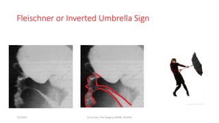 Fleischner or Inverted Umbrella Sign
7/7/2015 Dr.S.K.Jain, Prof Surgery, MAMC, N.Delhi
 