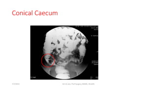 Conical Caecum
7/7/2015 Dr.S.K.Jain, Prof Surgery, MAMC, N.Delhi
 