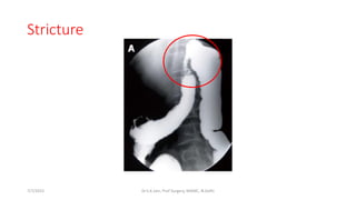Stricture
7/7/2015 Dr.S.K.Jain, Prof Surgery, MAMC, N.Delhi
 