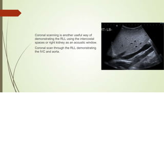 Interpostal Scanning Abdominal_Ultrasound__Liver (1).pptx understand | PPTX